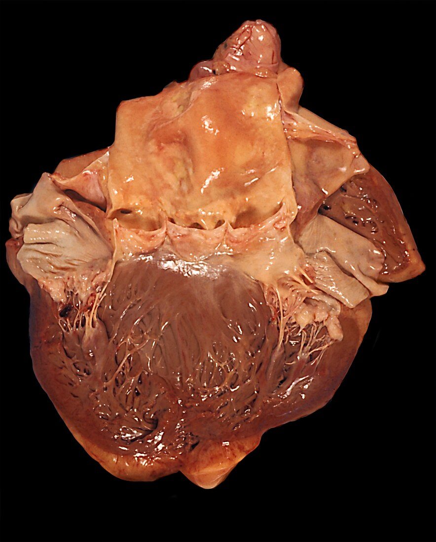 Human aortic valve