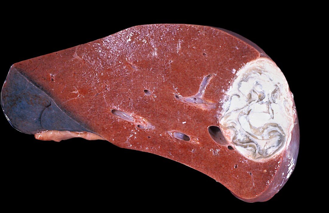 Hydatid cyst of the liver