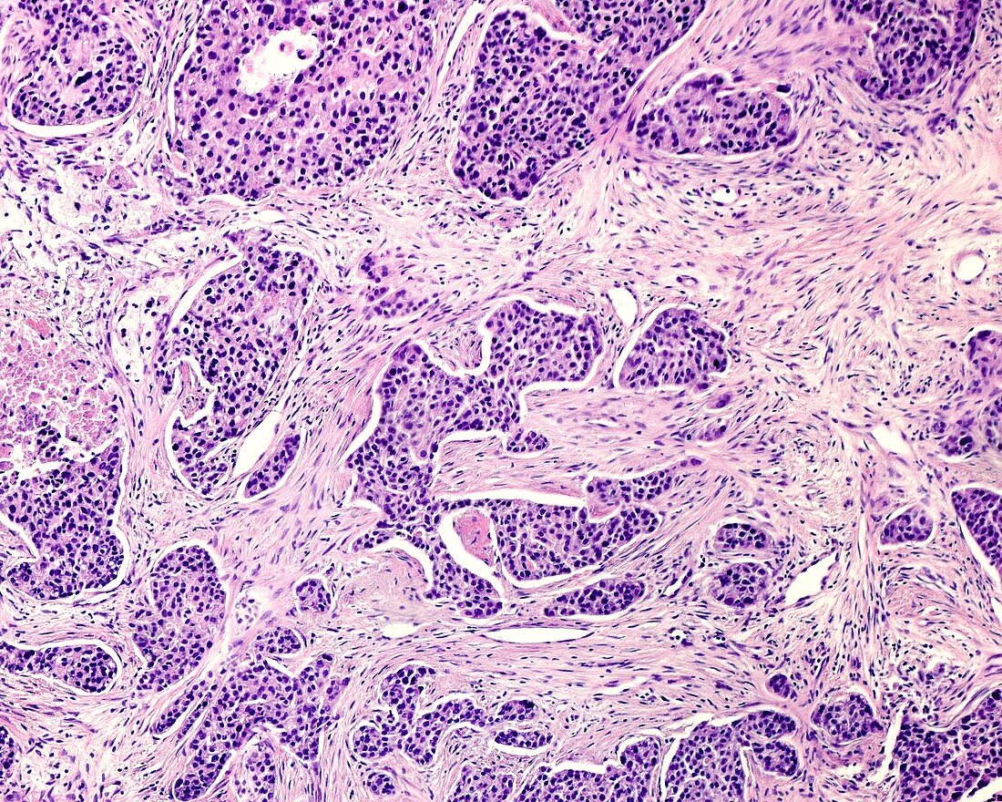 Invasive ductal carcinoma, light micrograph
