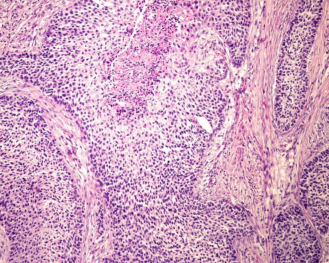 Basaloid squamous cell carcinoma, light micrograph