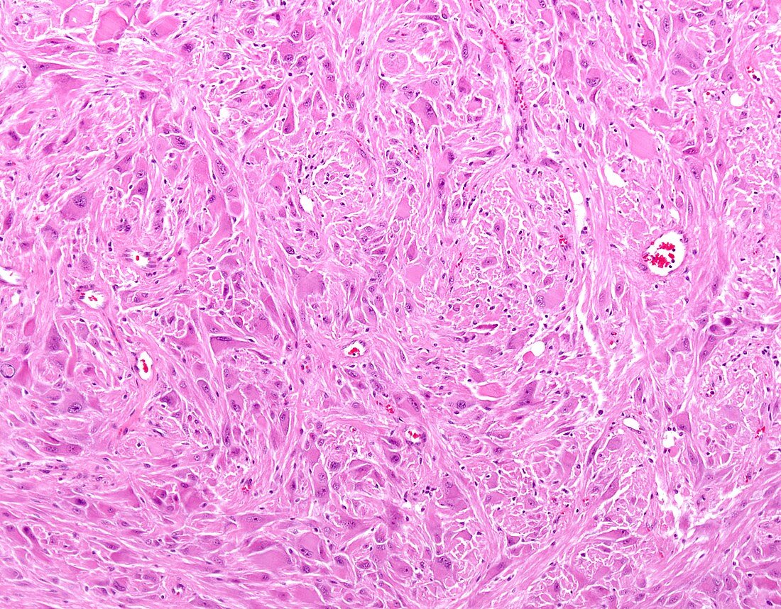 Subependymal giant cell astrocytoma, light micrograph