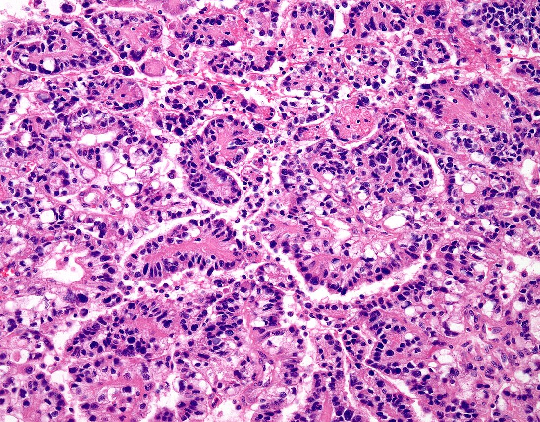 Choroid plexus carcinoma, light micrograph
