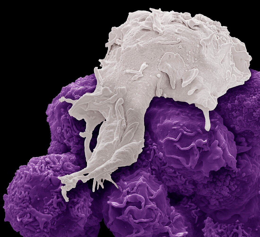 Macrophage and cancer cells, SEM