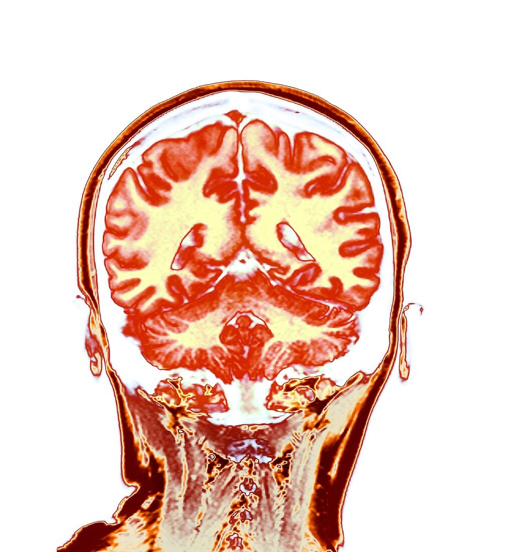 Healthy brain, MRI scan