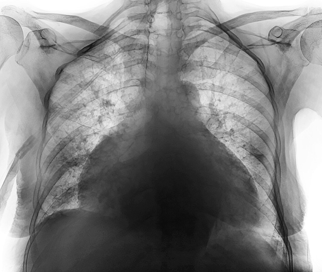 Enlarged heart in Covid-19 patient, X-ray