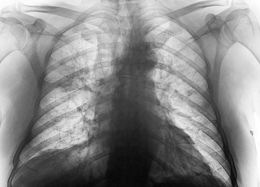 Lungs affected by Covid-19, X-ray