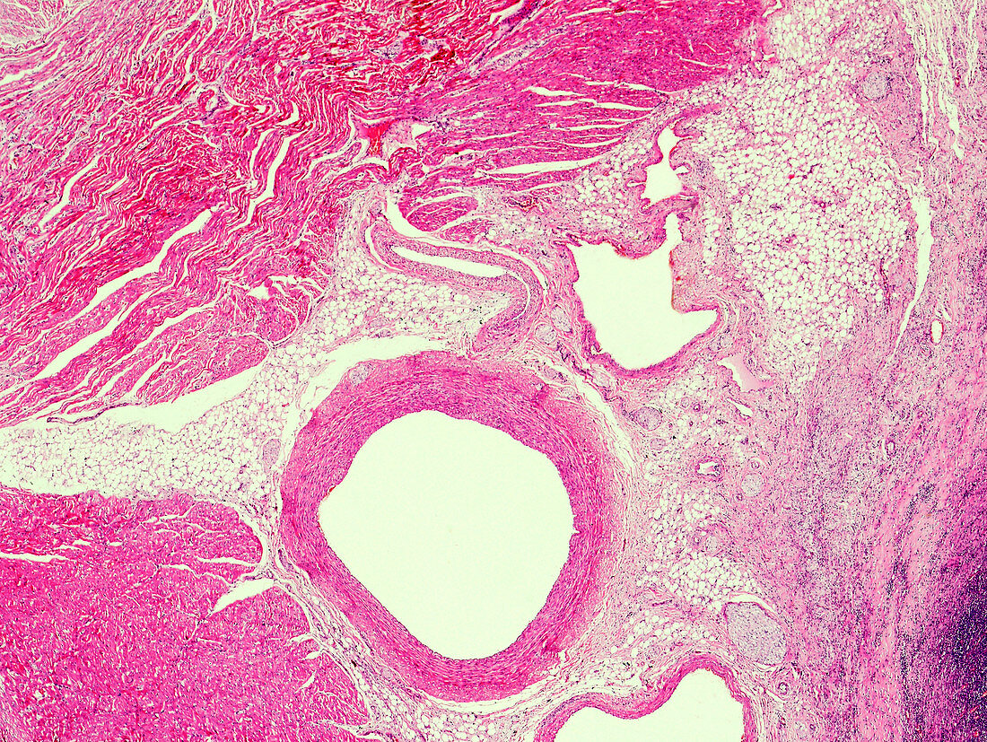 Fibrinous pericarditis, light micrograph