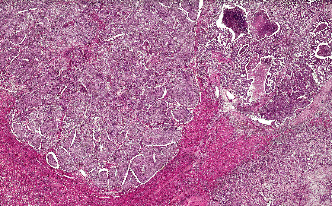 Hepatocellular carcinoma, light micrograph