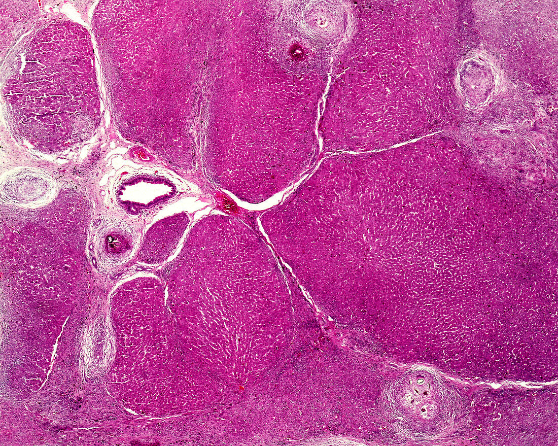 Hepatic schistosomiasis, light micrograph