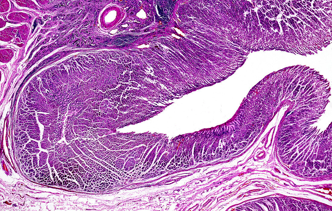 Adenocarcinoma of the stomach, light micrograph