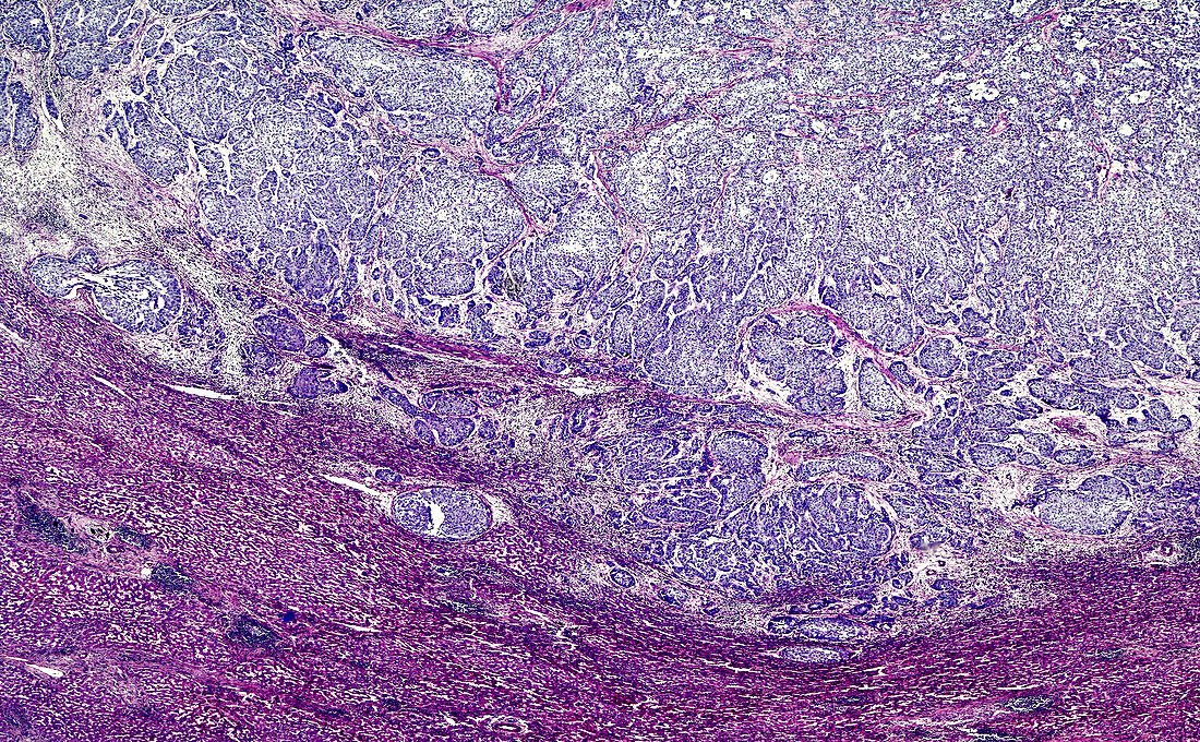 Bile duct cancer, light micrograph