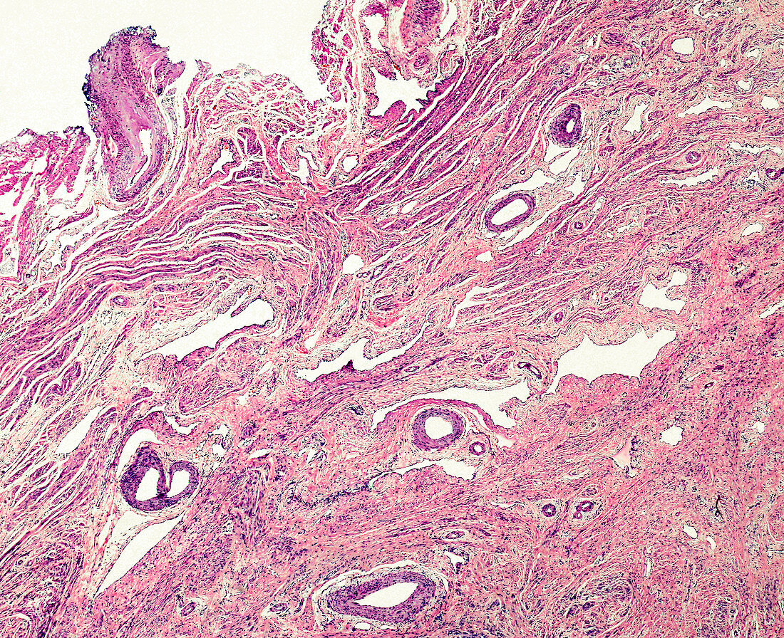 Squamous cell metaplasia of the cervix, light micrograph