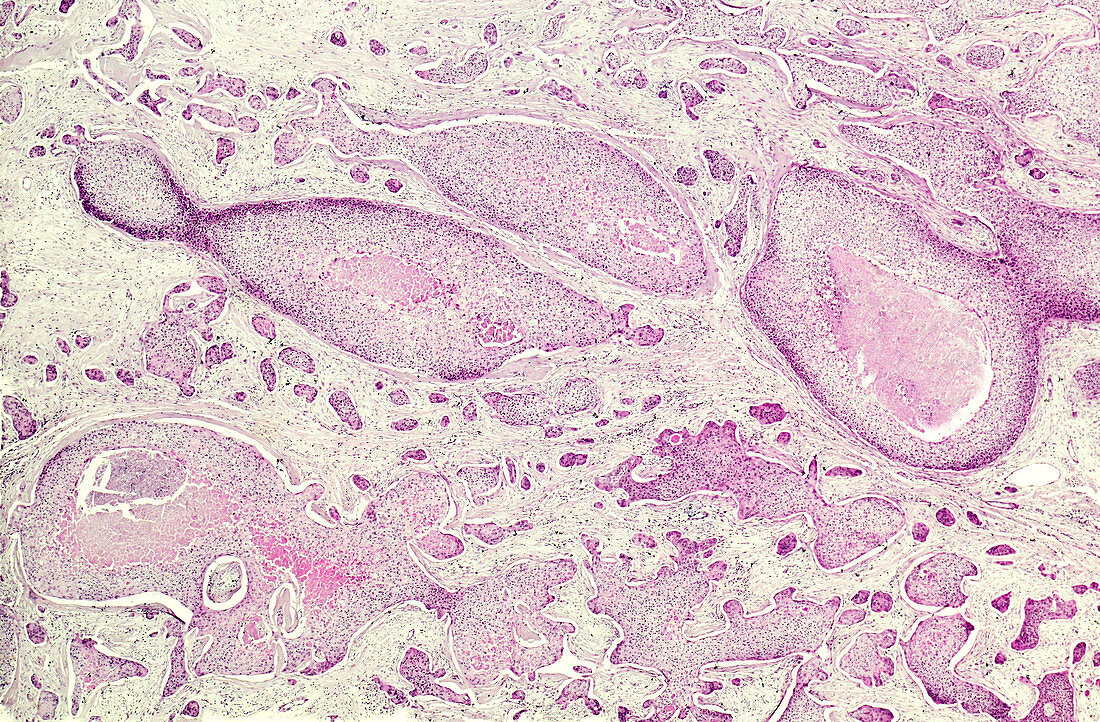 Basal cell carcinoma, light micrograph