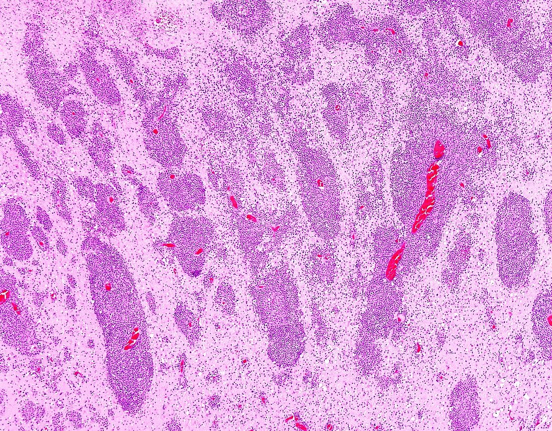 Diffuse large B-cell lymphoma AIDS-related, light micrograph