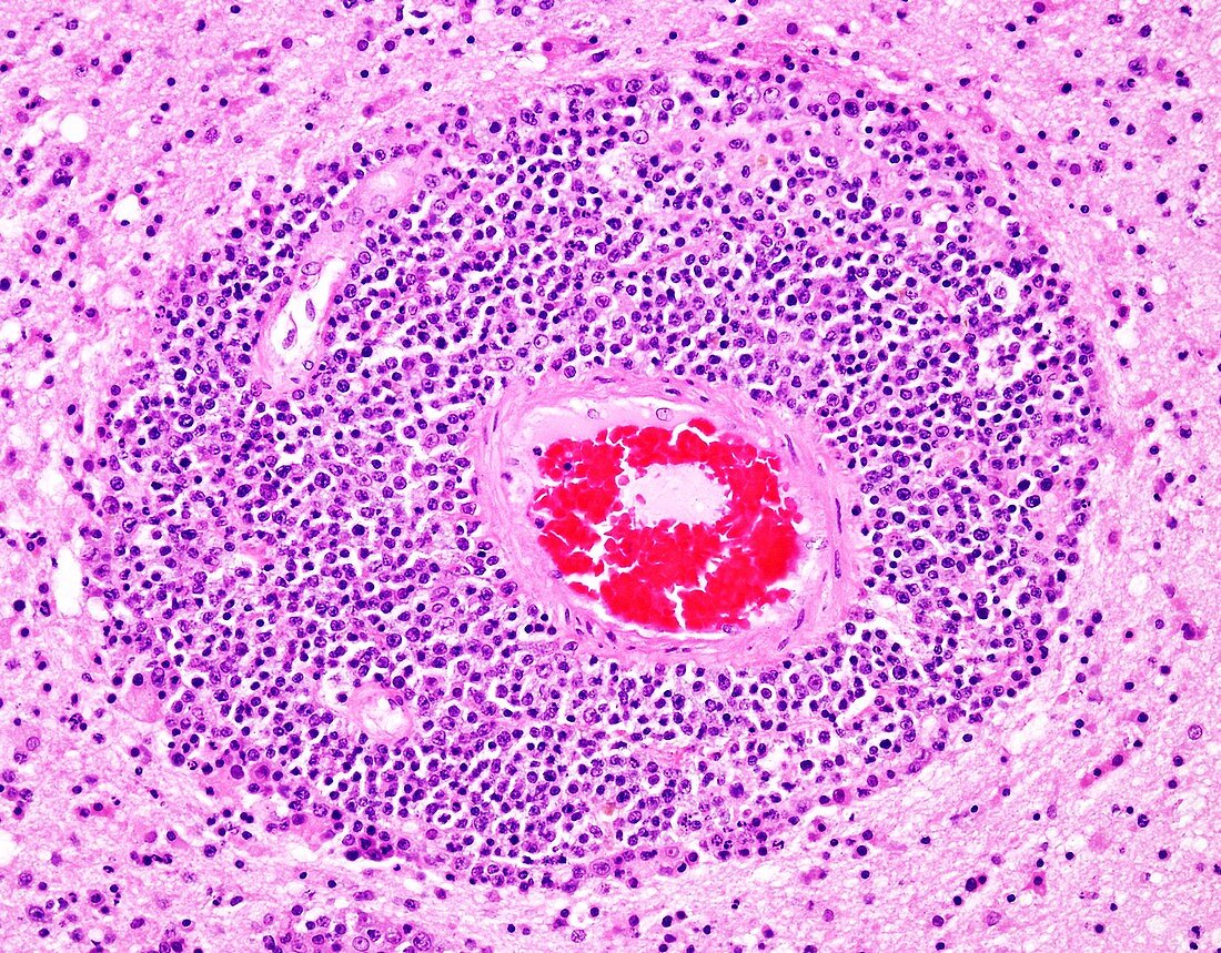 Diffuse large B-cell lymphoma AIDS-related, light micrograph