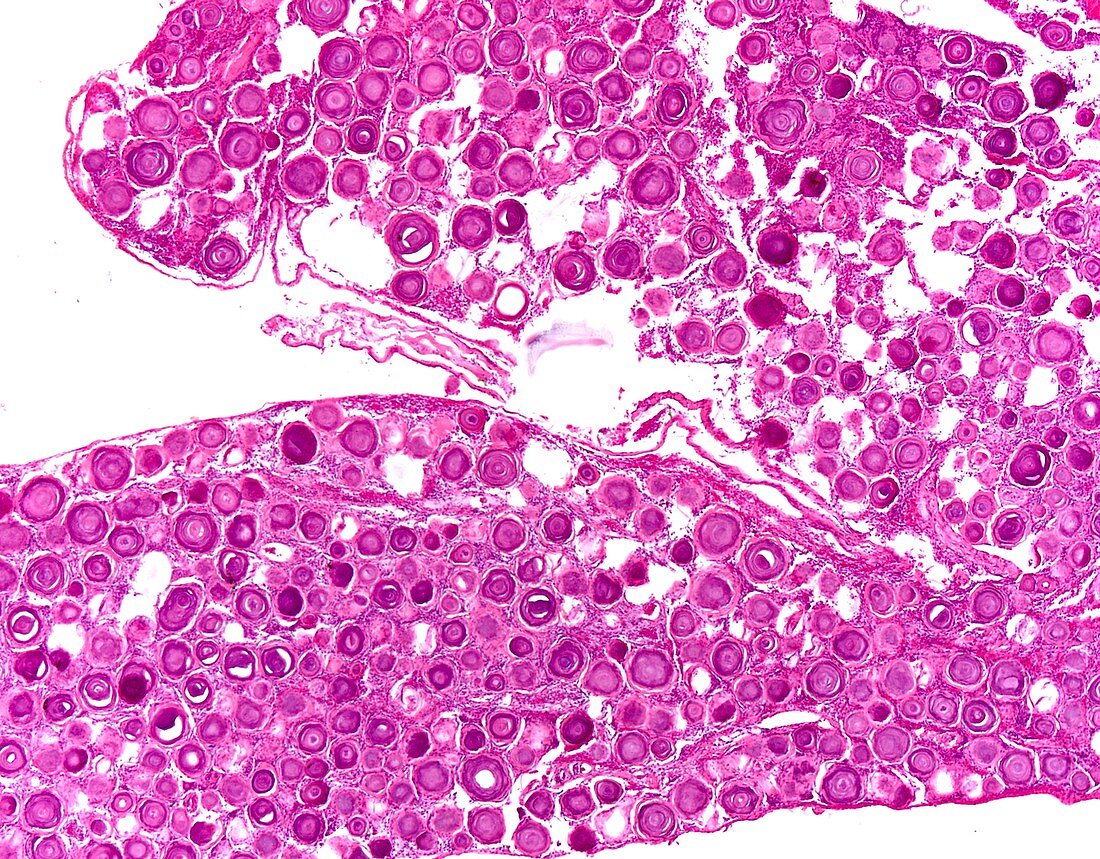 Psammomatous meningioma, light micrograph