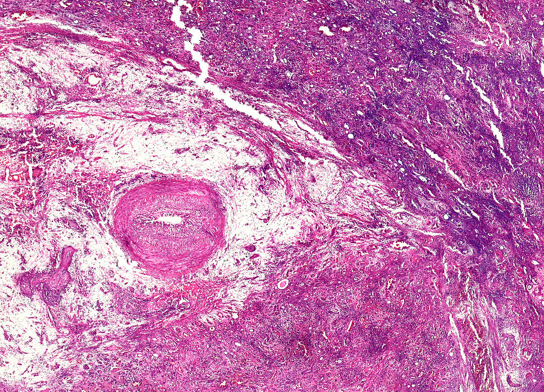 Chronic glomerulonephritis, light micrograph