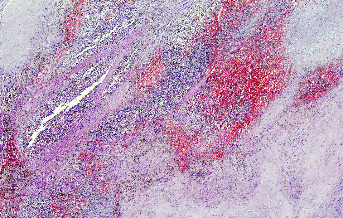 Pulmonary amniotic fluid embolism, light micrograph