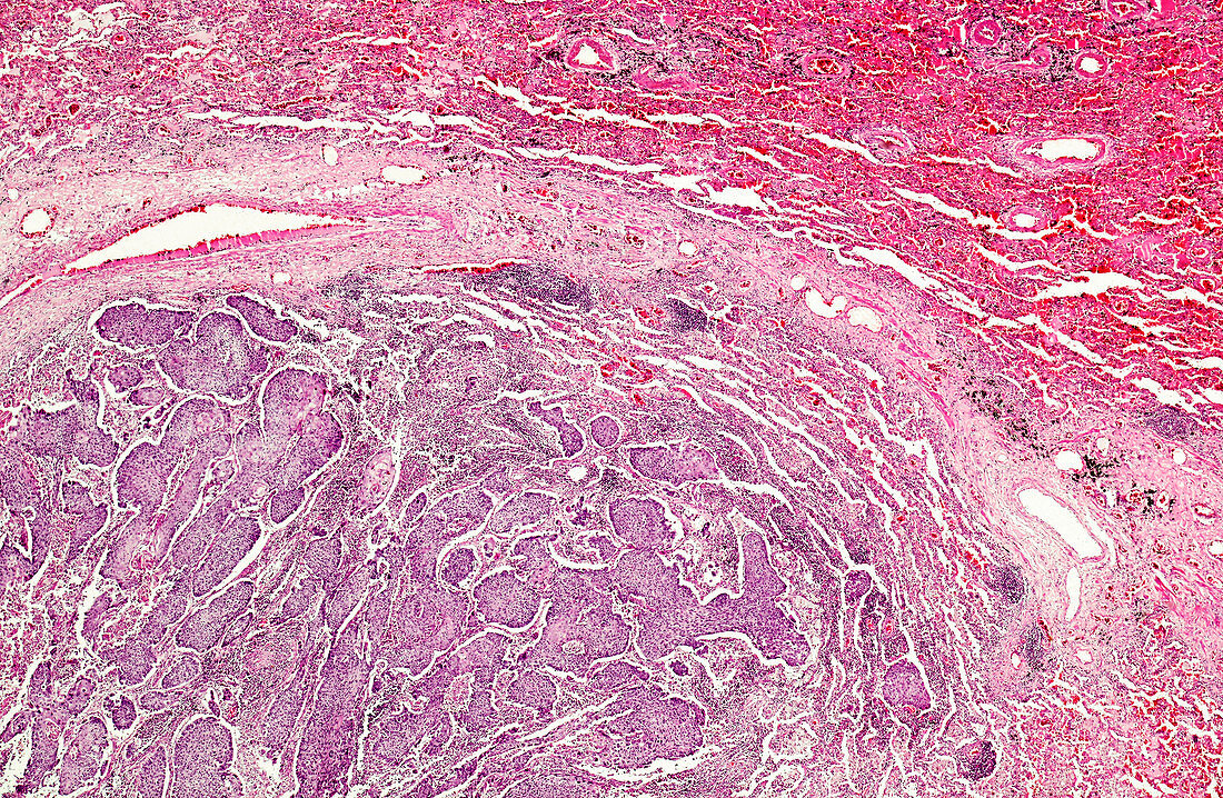 Squamous cell carcinoma of the lung, light micrograph