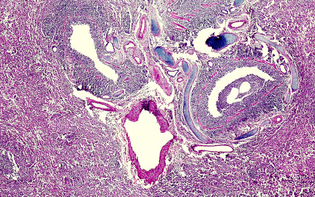 Viral pneumonia, light micrograph