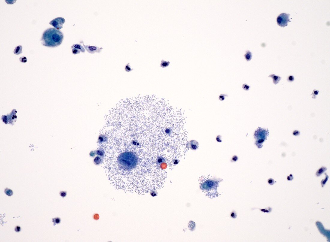 Bacteria in urine, light micrograph