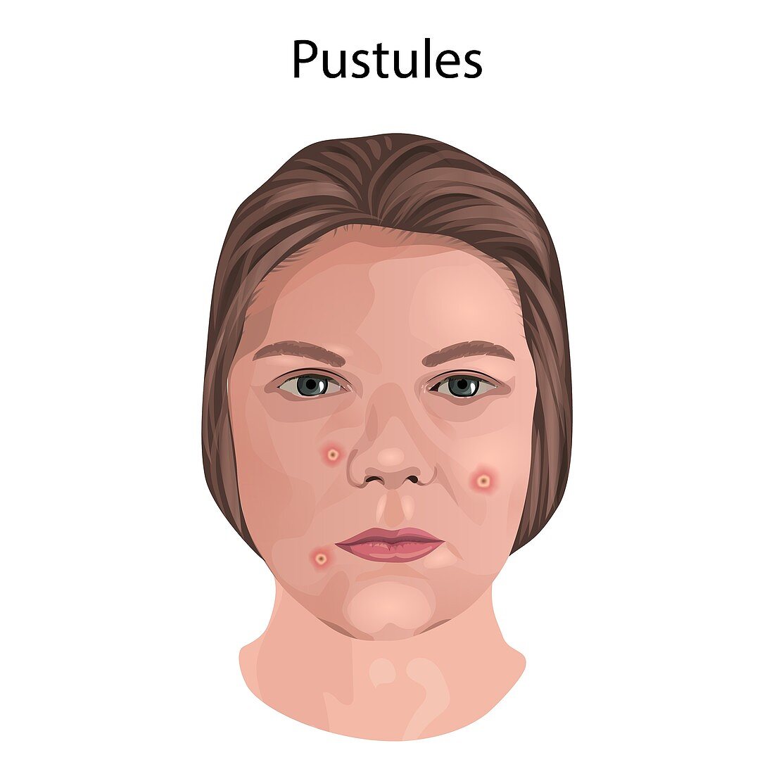 Pustules, illustration