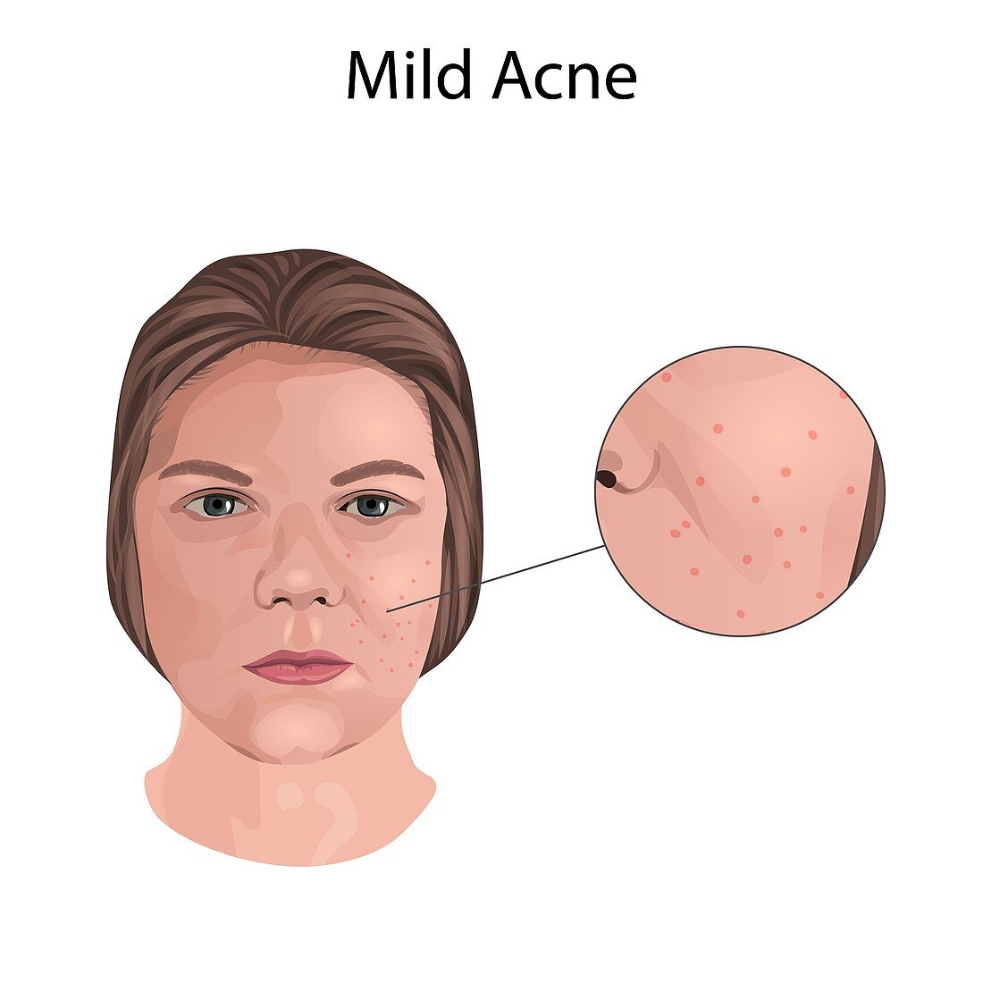 Mild acne, illustration