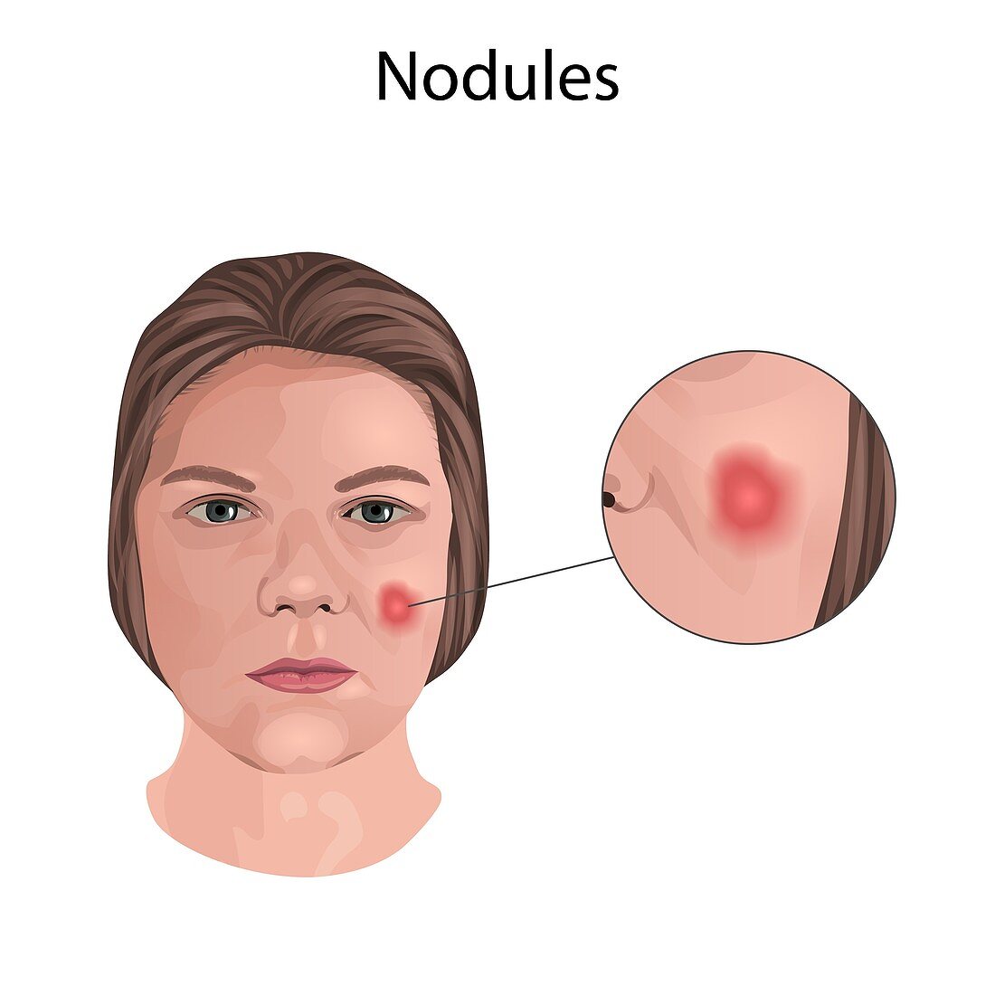 Nodules, illustration