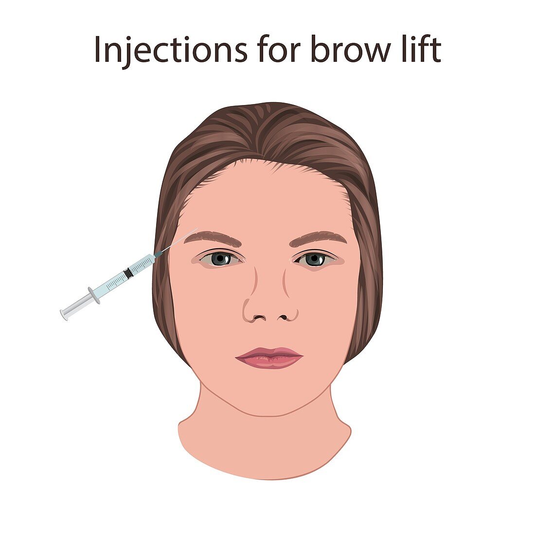 Injections for brow lift, illustration