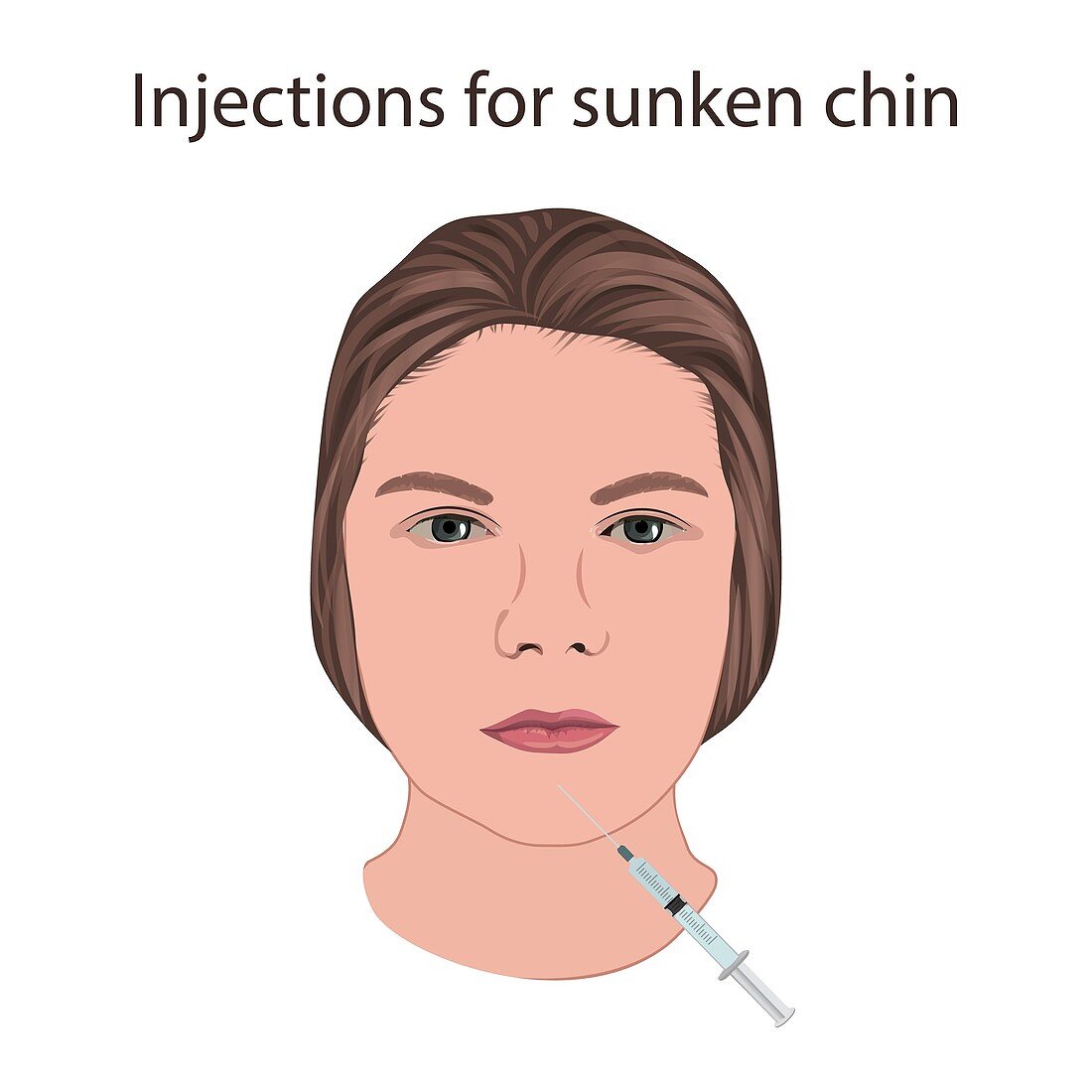 Injections for sunken chin, illustration