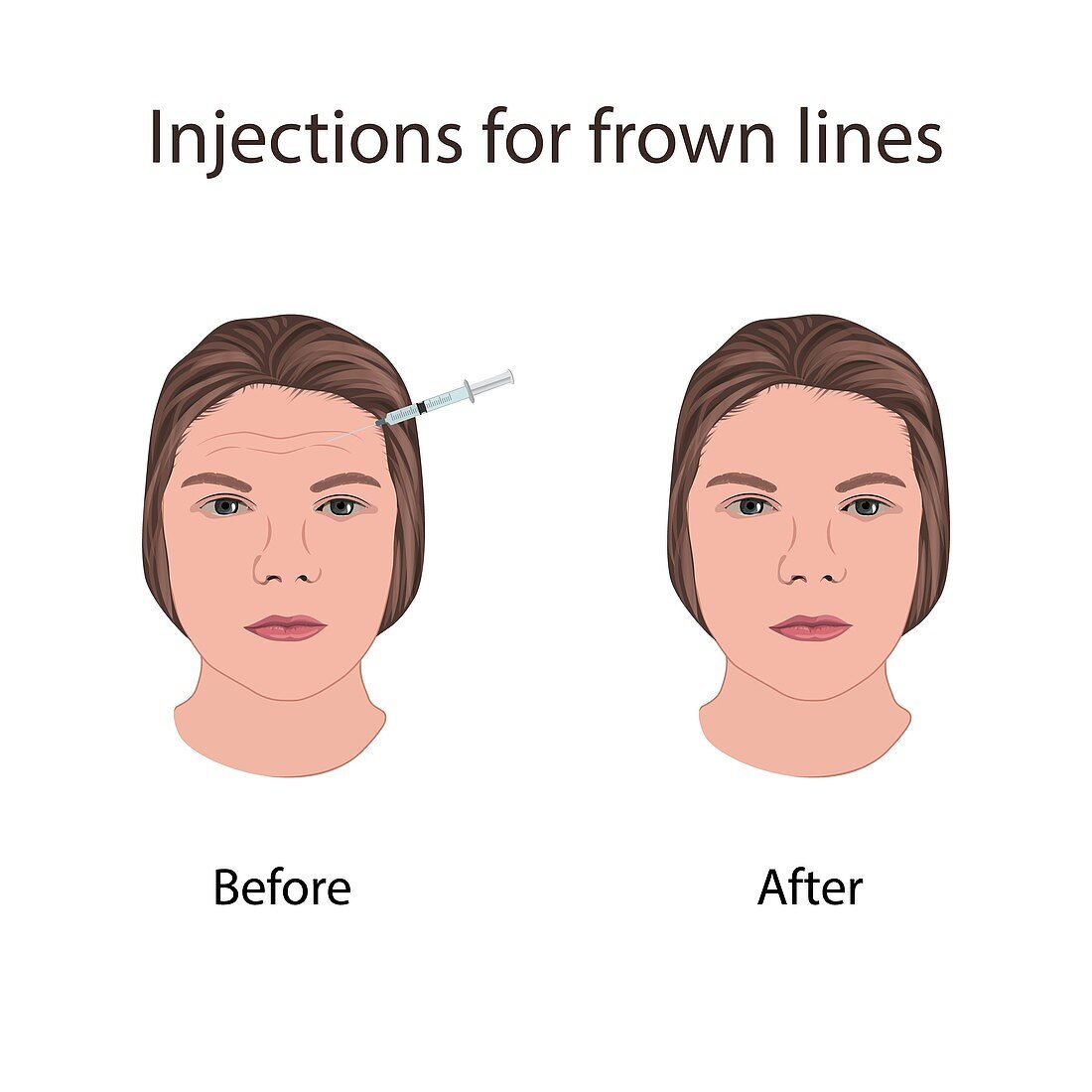 Injections for frown lines, illustration