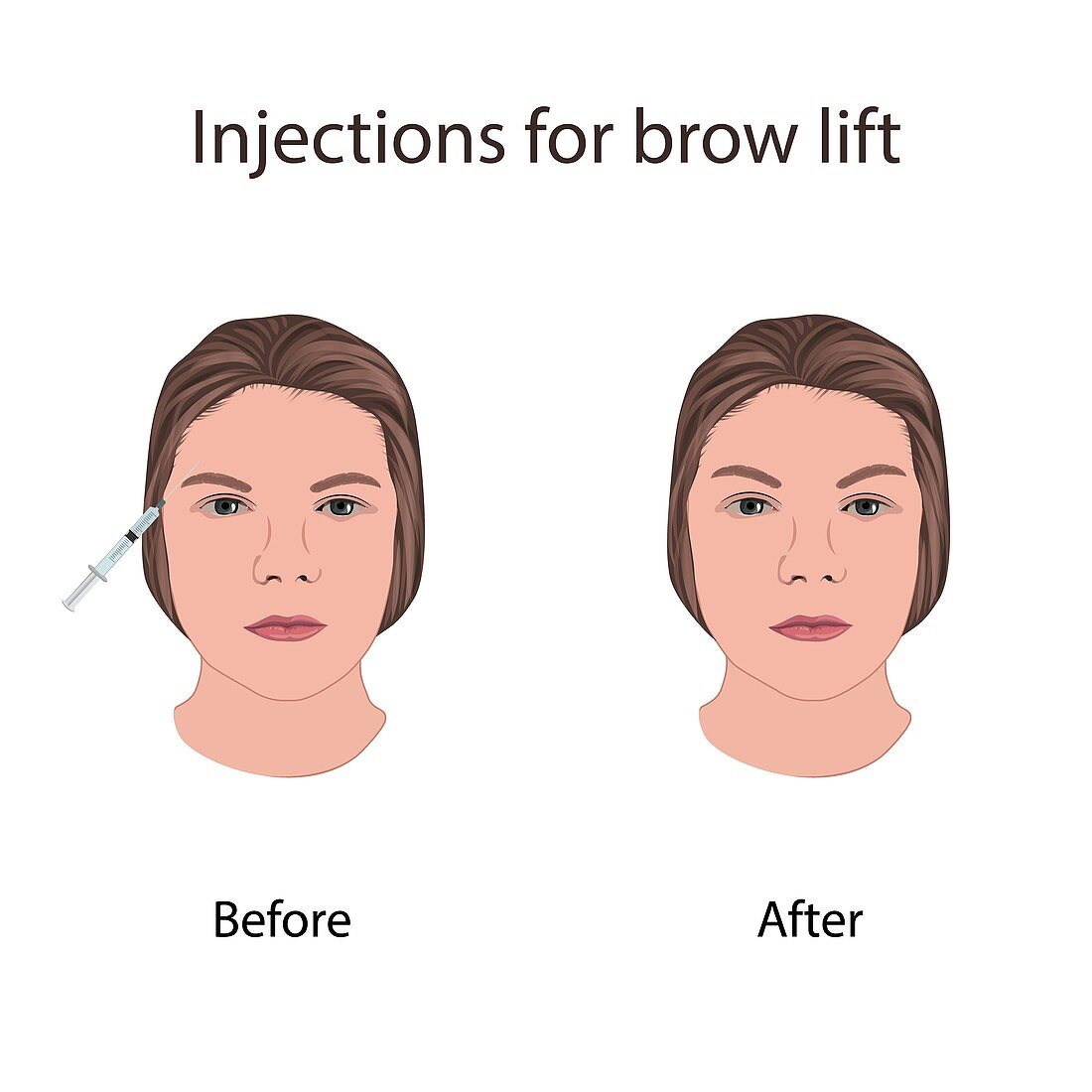 Injections for brow lift, illustration