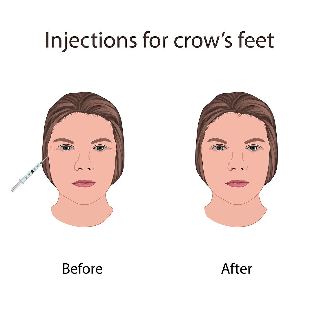 Injections for crow's feet, illustration