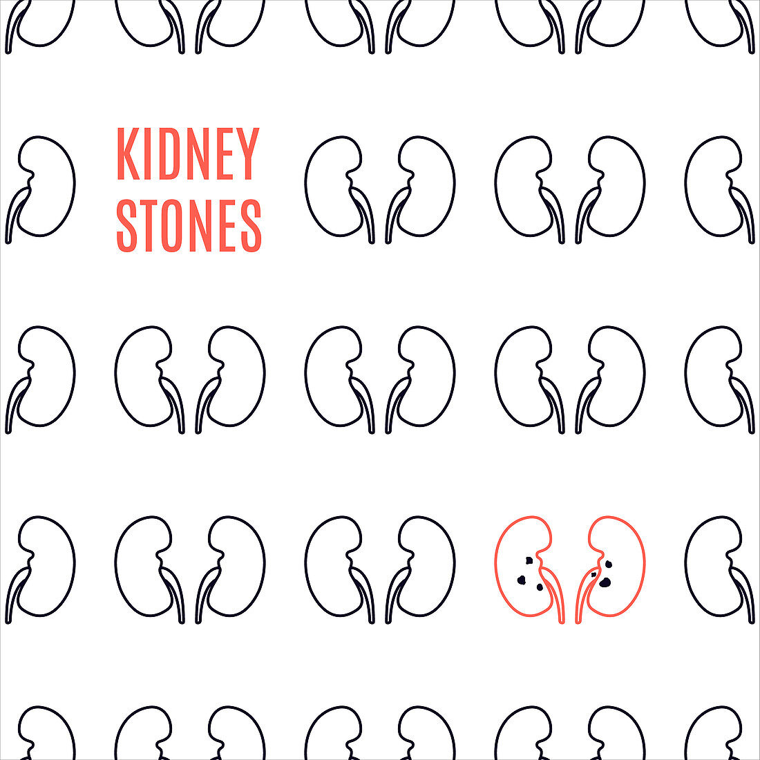 Kidney stone disease, illustration