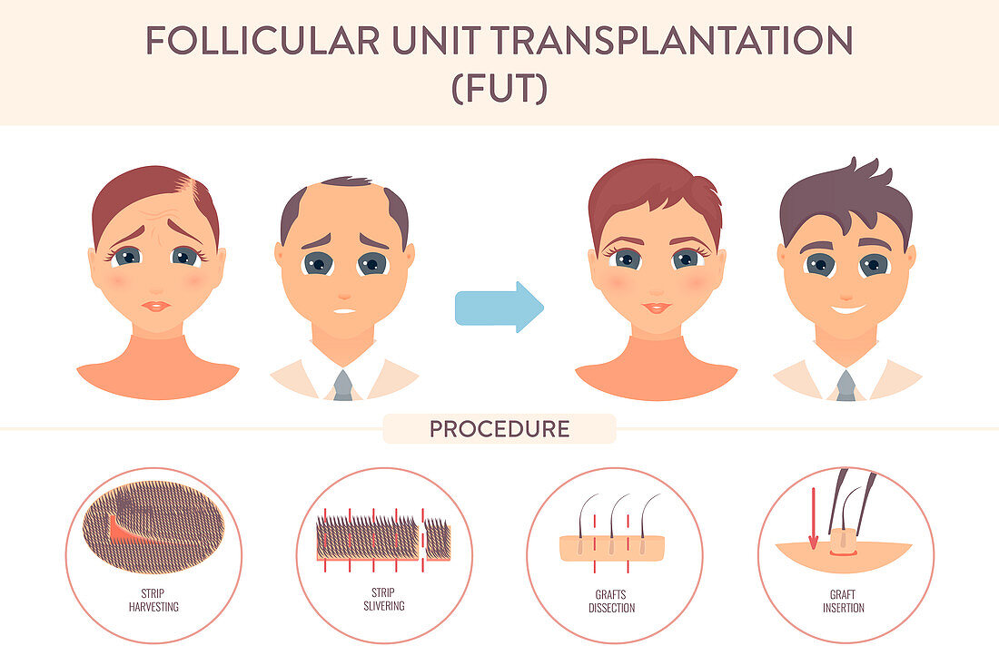 FUT hair transplantation, conceptual illustration
