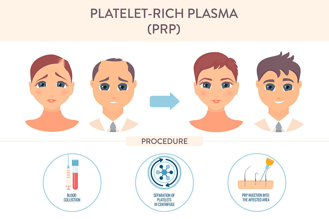 PRP hair loss treatment, conceptual illustration