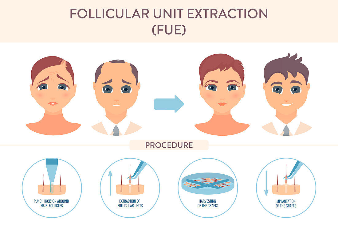 FUE hair transplantation, conceptual illustration