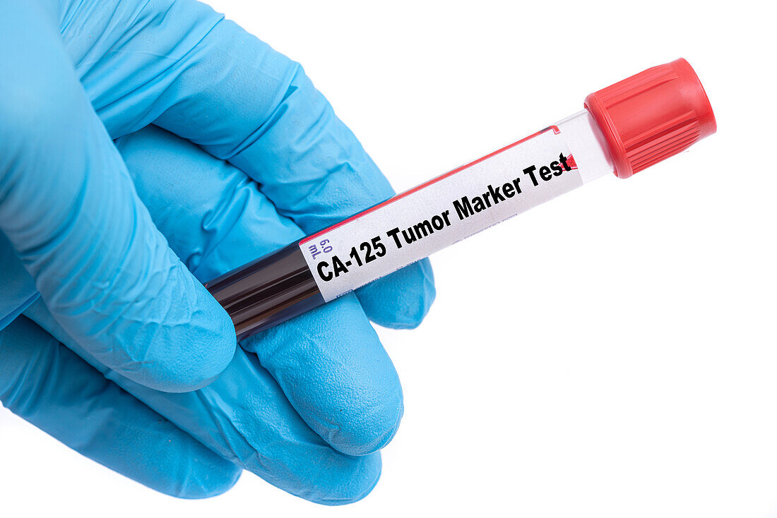 CA-125 tumour marker test, conceptual image