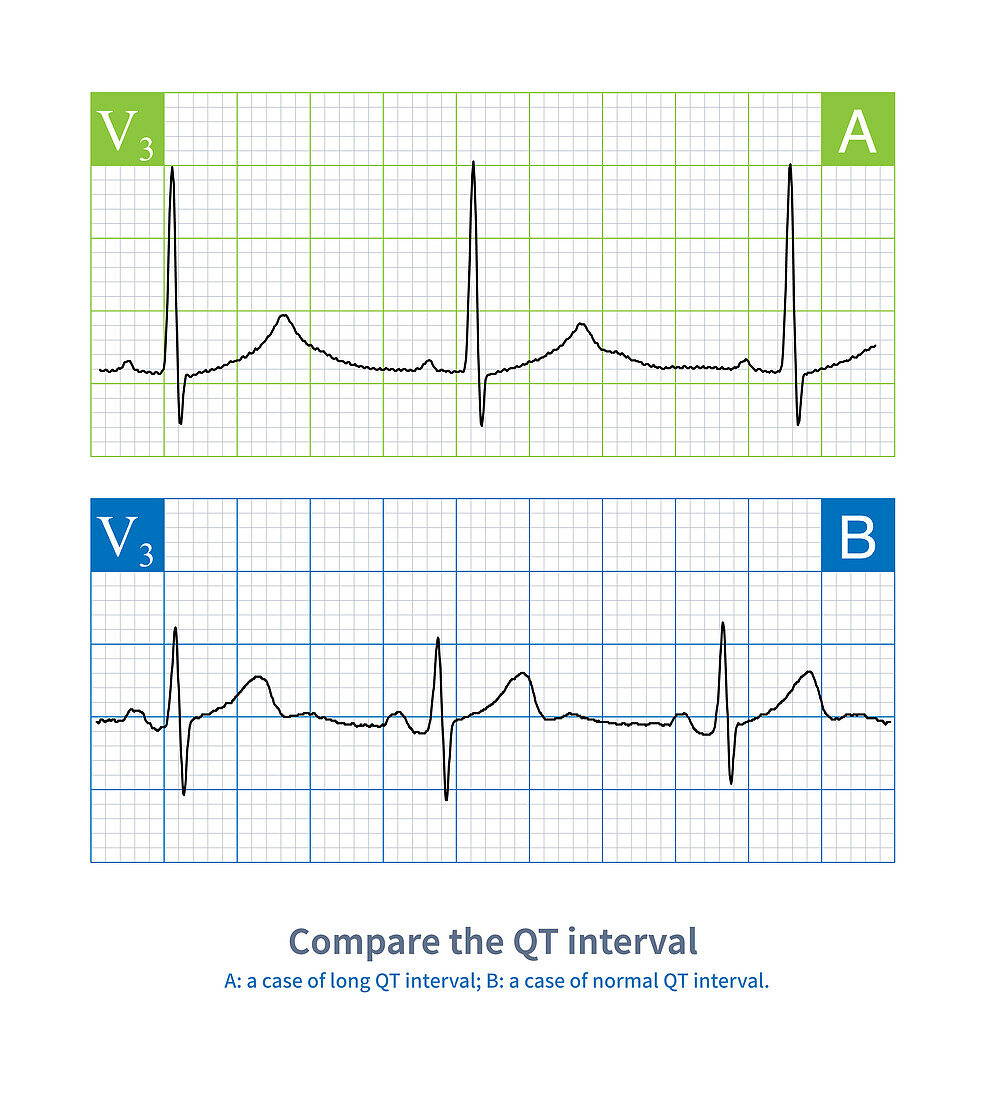 Long and normal QT intervals, illustration