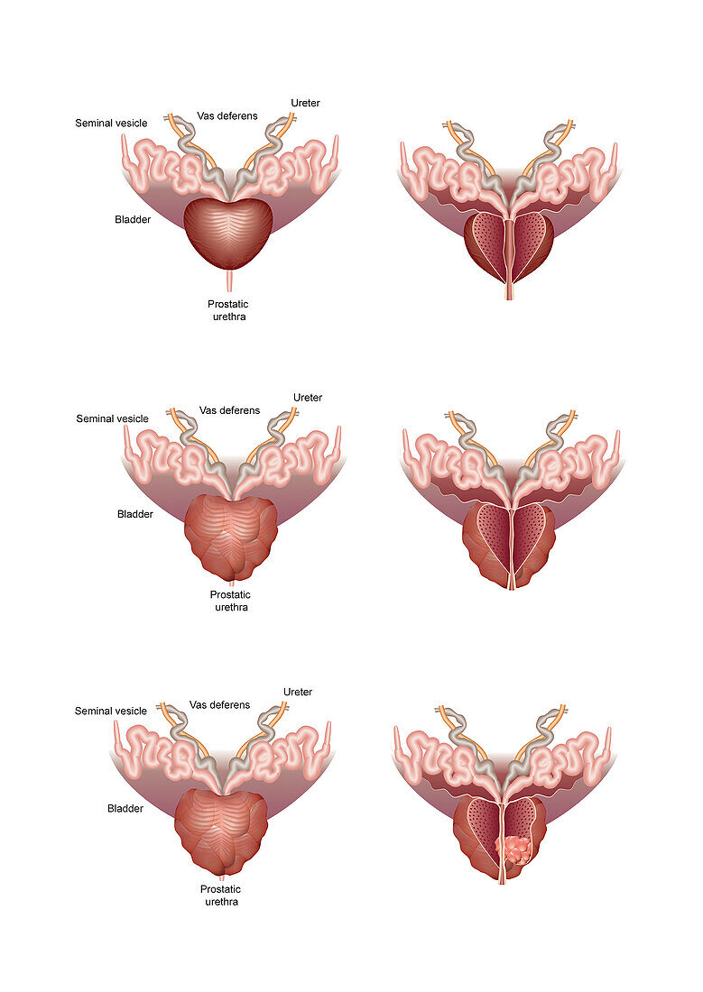 Healthy and unhealthy prostate glands, illustration
