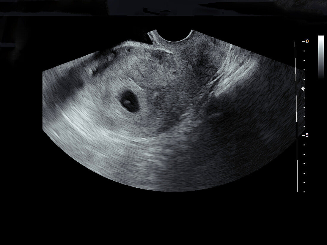 Embryo at six weeks, ultrasound scan