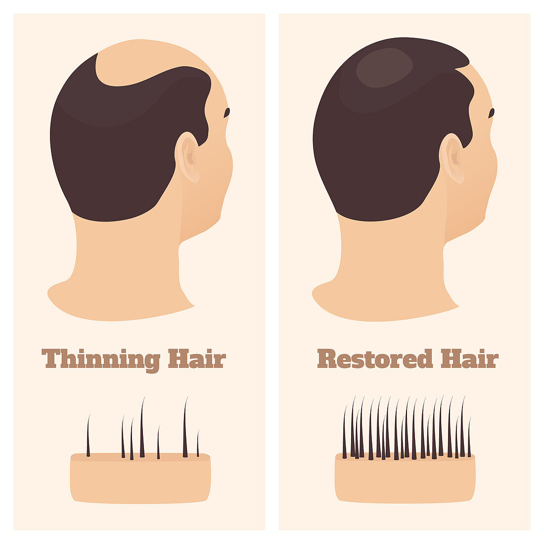 Alopecia in men, conceptual illustration