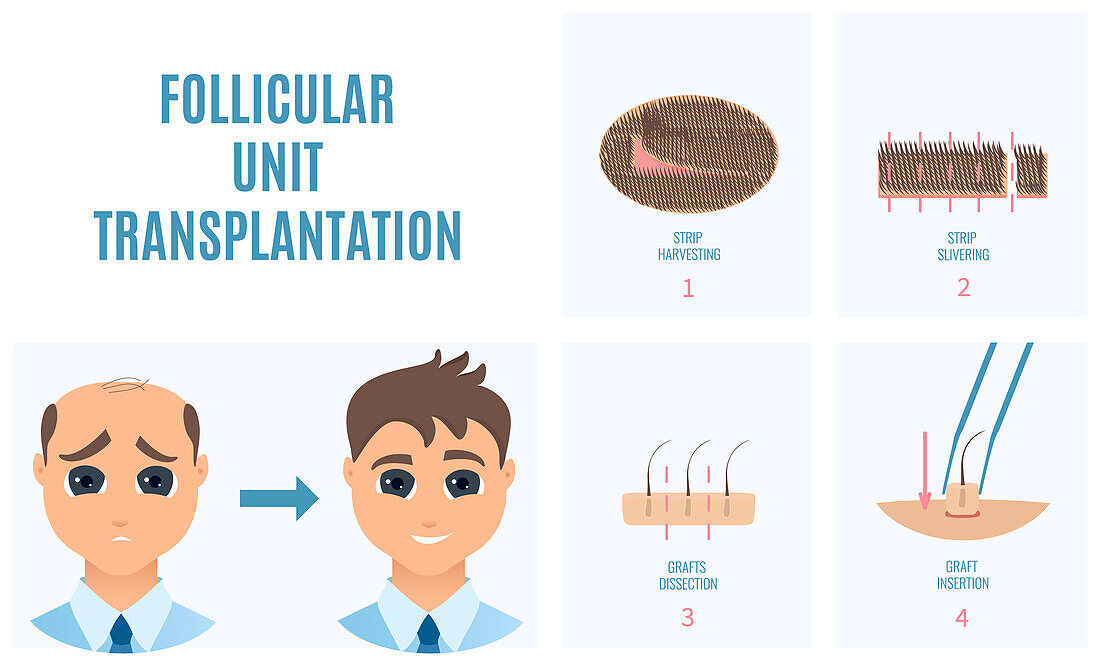 FUT hair loss treatment, conceptual illustration
