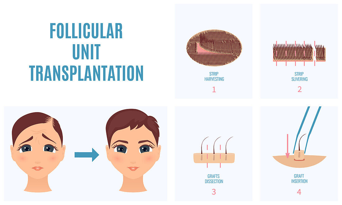 FUT hair loss treatment, conceptual illustration
