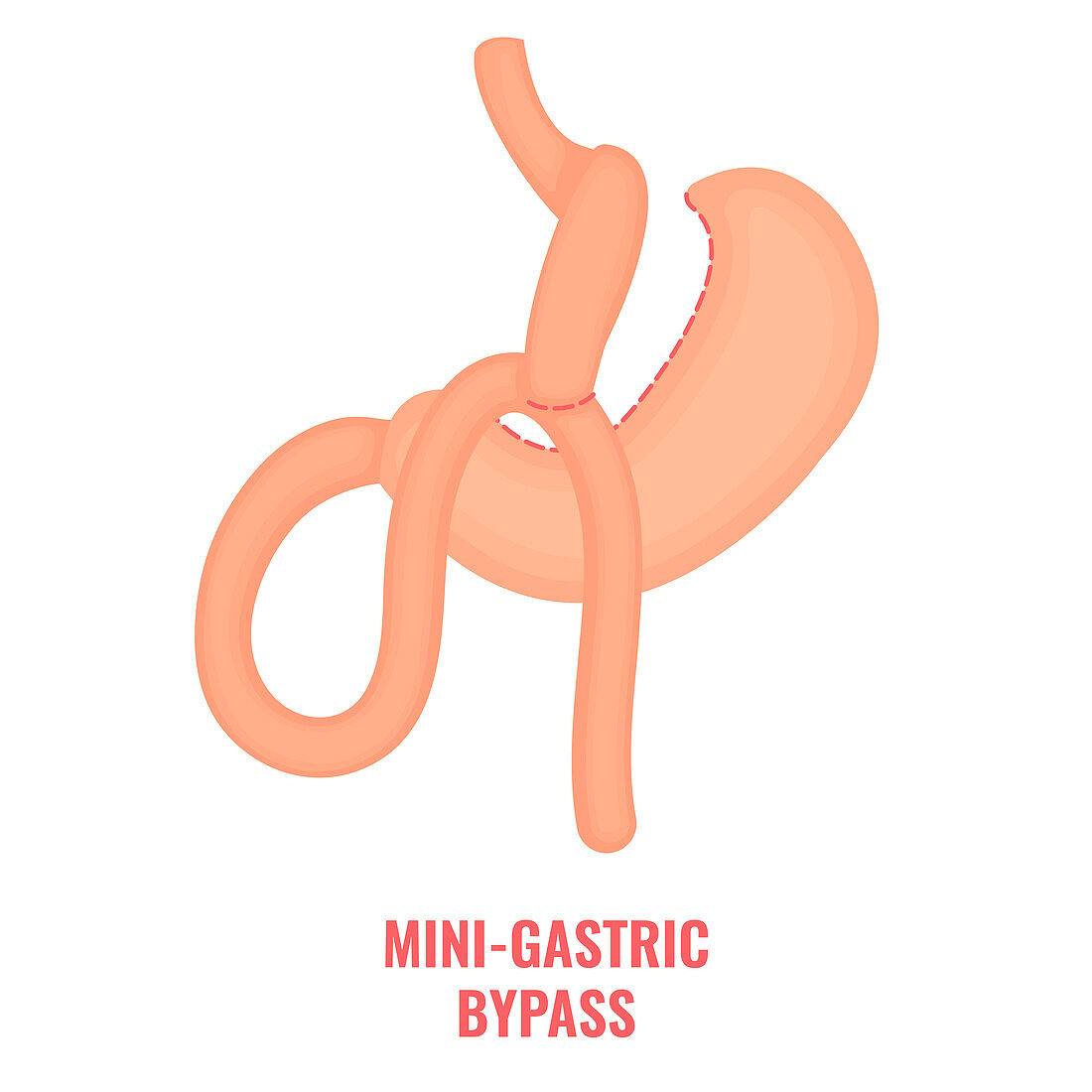 Mini gastric bypass bariatric surgery, illustration
