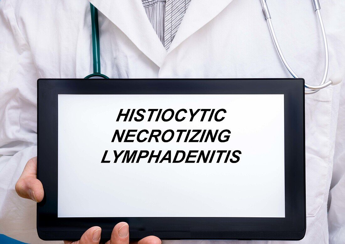 Histiocytic necrotizing lymphadenitis, conceptual image