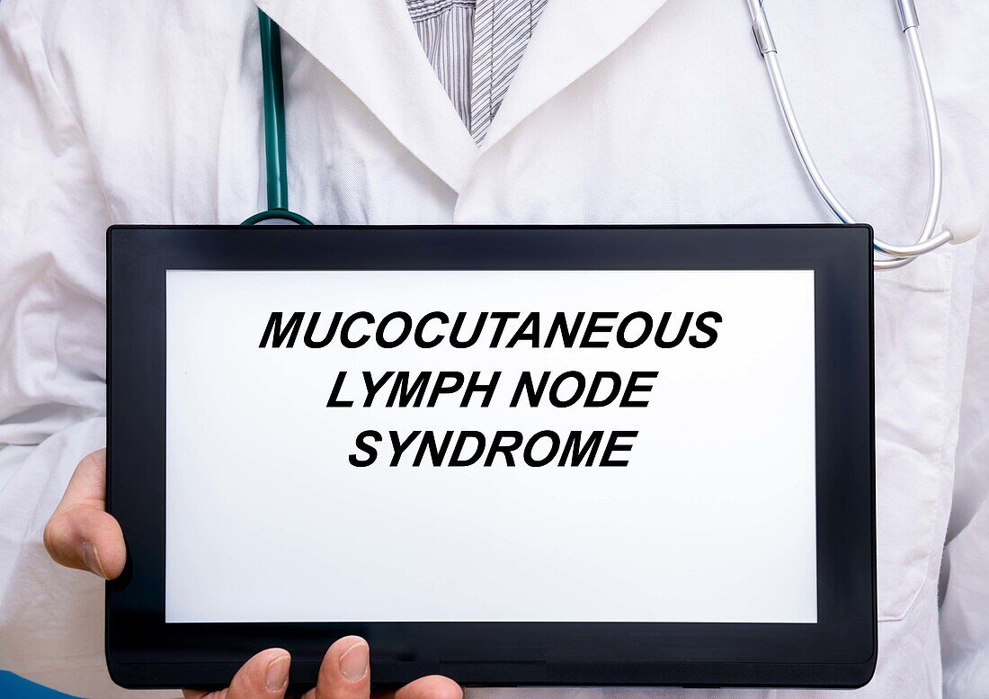 Mucocutaneous lymph node syndrome, conceptual image