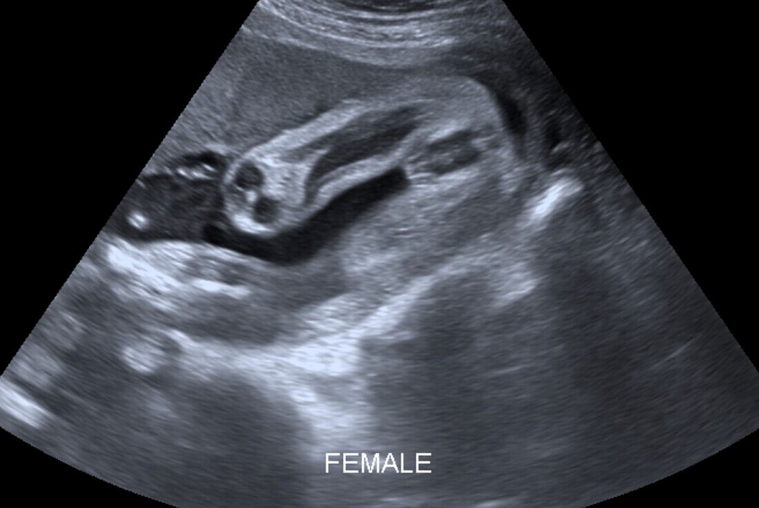 Baby girl, ultrasound scan