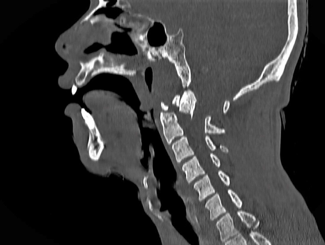 Dislocated neck bones, CT scan