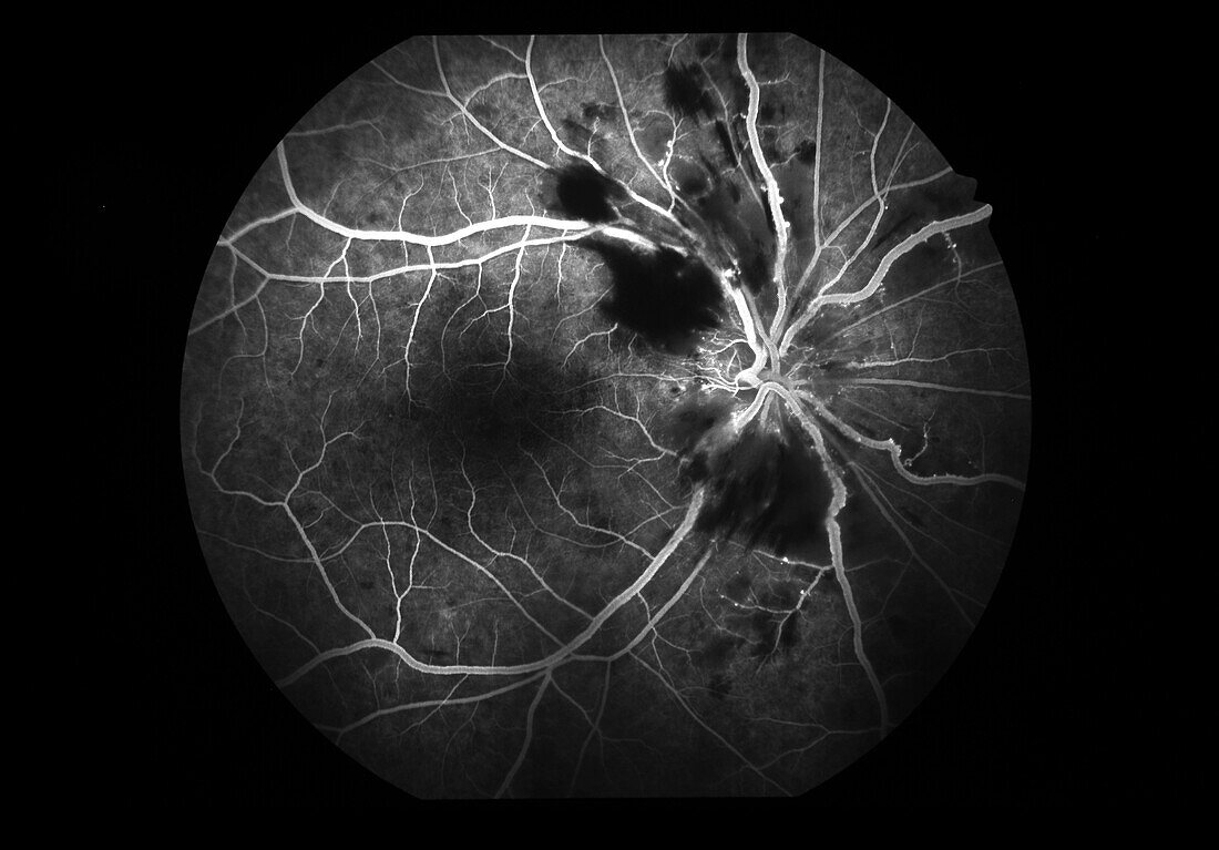 Anterior ischemic optic neuropathy, angiogram